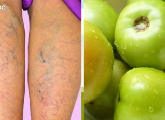 შესანიშნავი ფარული საშუალება, რომელიც ყველას გვაქვს სახლში და რომელიც შეგიძლიათ ვარიკოზული ვენების მკურნალობა!