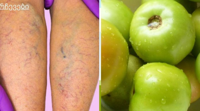 შესანიშნავი ფარული საშუალება, რომელიც ყველას გვაქვს სახლში და რომელიც შეგიძლიათ ვარიკოზული ვენების მკურნალობა!