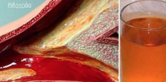 კინაღამ მოვკვდი გულის შეტევით დახშული არტერიების გამო, მაგრამ ეს სასმელი დამეხმარა მათ გაწმენდაში!