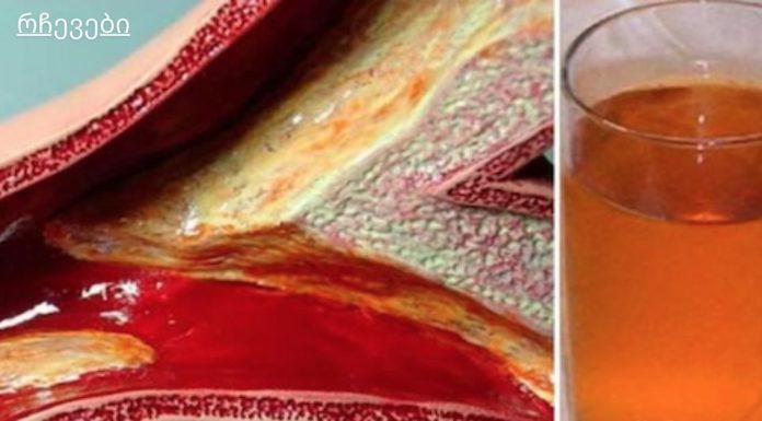 კინაღამ მოვკვდი გულის შეტევით დახშული არტერიების გამო, მაგრამ ეს სასმელი დამეხმარა მათ გაწმენდაში!