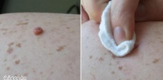 წაისვით ეს ბუნებრივი ინგრედიენტი თქვენს მეჭეჭებზე და ისინი მალე გაქრება!