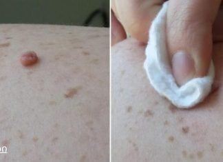 წაისვით ეს ბუნებრივი ინგრედიენტი თქვენს მეჭეჭებზე და ისინი მალე გაქრება!