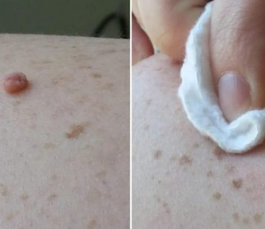 წაისვით ეს ბუნებრივი ინგრედიენტი თქვენს მეჭეჭებზე და ისინი მალე გაქრება!