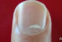 „წითელი გაფრთხილება“: თუ ეს თქვენს ფრჩხილებზე დაინახეთ, სასწრაფოდ მიმართეთ ექიმს!