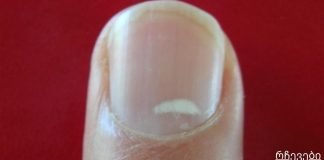 „წითელი გაფრთხილება“: თუ ეს თქვენს ფრჩხილებზე დაინახეთ, სასწრაფოდ მიმართეთ ექიმს!