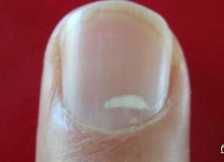 „წითელი გაფრთხილება“: თუ ეს თქვენს ფრჩხილებზე დაინახეთ, სასწრაფოდ მიმართეთ ექიმს!