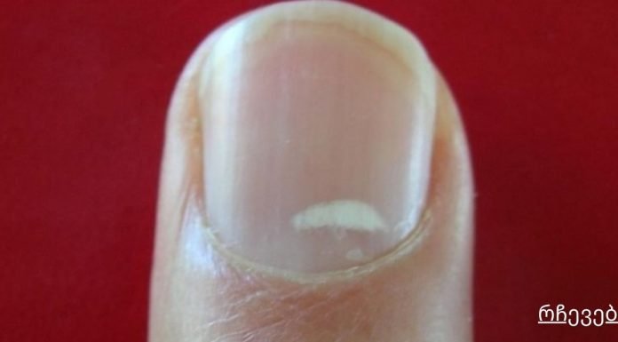 „წითელი გაფრთხილება“: თუ ეს თქვენს ფრჩხილებზე დაინახეთ, სასწრაფოდ მიმართეთ ექიმს!