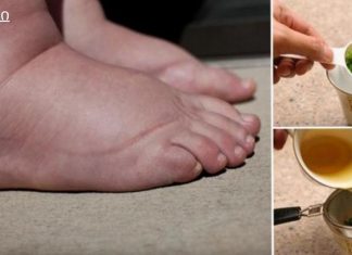 მე გამუდმებით ვიტანჯებოდი ფეხების გასიებით, სანამ არ შევისწავლე ამ სახლის ჩაის შესახებ! შეშუპება გაქრა რამდენიმე დღეში და აღარ მაწუხებს!