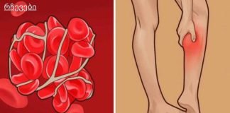 8 ნიშანი იმისა, რომ შესაძლოა თრომბები გქონდეთ!