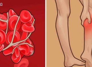 8 ნიშანი იმისა, რომ შესაძლოა თრომბები გქონდეთ!