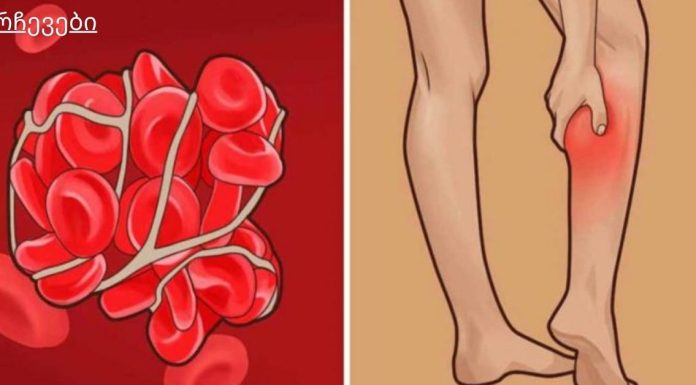 8 ნიშანი იმისა, რომ შესაძლოა თრომბები გქონდეთ!