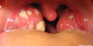 როგორ მოვიშოროთ ტონზილიტი და ტონზილიტი? მეთოდი რომელიც არ იცი და Შენ უნდა იცოდე!