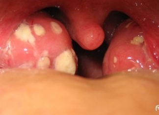 როგორ მოვიშოროთ ტონზილიტი და ტონზილიტი? მეთოდი რომელიც არ იცი და Შენ უნდა იცოდე!