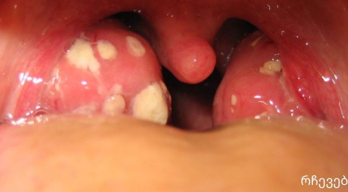 როგორ მოვიშოროთ ტონზილიტი და ტონზილიტი? მეთოდი რომელიც არ იცი და Შენ უნდა იცოდე!