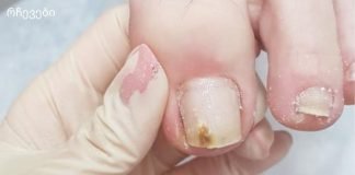 სოკოვანი დაავადება ოჯახში ერთს მაინც აწუხებს.მოიცილეთ სოკო ამ ბუნებრივი სამ ინგრედიენტიანი რეცეპტით