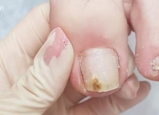 სოკოვანი დაავადება ოჯახში ერთს მაინც აწუხებს.მოიცილეთ სოკო ამ ბუნებრივი სამ ინგრედიენტიანი რეცეპტით