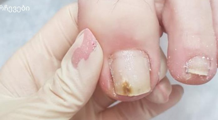 სოკოვანი დაავადება ოჯახში ერთს მაინც აწუხებს.მოიცილეთ სოკო ამ ბუნებრივი სამ ინგრედიენტიანი რეცეპტით