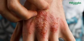 ეთერზეთი, რომელიც ებრძვის აკნეს, ეგზემასა და ფსორიაზს!