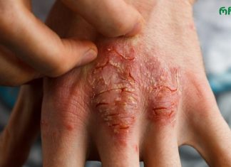 ეთერზეთი, რომელიც ებრძვის აკნეს, ეგზემასა და ფსორიაზს!