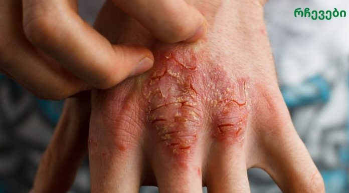 ეთერზეთი, რომელიც ებრძვის აკნეს, ეგზემასა და ფსორიაზს!