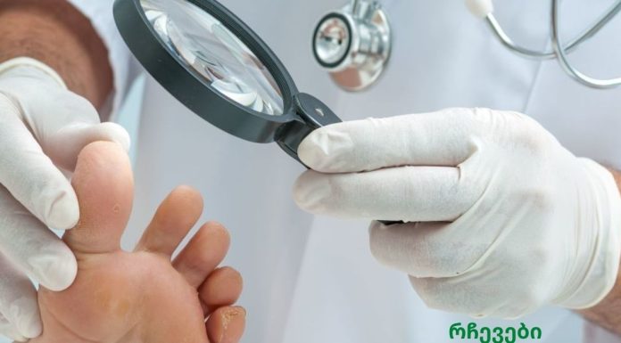 საუკეთესო საშინაო საშუალებები ფრჩხილის სოკოს მოსაშორებლად!