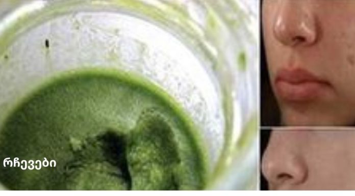 ეს მწვანე პასტა მოგაცილებთ ნაწიბურებს სახიდან მხოლოდ 3 დღეში!