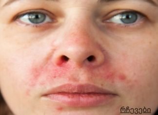 კანის გაღიზიანების მკურნალობა.ძალიან ხშირია პირბადით გამოწვეული გაღიზიანება,სახლში მოუარეთ კანს ყველაზე იაფად.