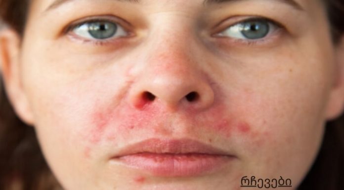 კანის გაღიზიანების მკურნალობა.ძალიან ხშირია პირბადით გამოწვეული გაღიზიანება,სახლში მოუარეთ კანს ყველაზე იაფად.