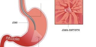 კუჭის წყლულის მკურნალობა სხვადასხვა გზით