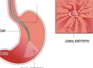 კუჭის წყლულის მკურნალობა სხვადასხვა გზით