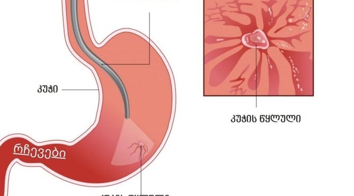 კუჭის წყლულის მკურნალობა სხვადასხვა გზით