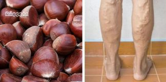 თრომბოზი და ვარიკოზული ვენები იკურნება ხალხური მეთოდებით. წინაპრების სიბრძნე ჯანმრთელობის დაცვის შესახებ!