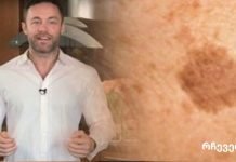 ცნობილი დერმატოლოგის თქმით ამ პროდუქტით შეგიძლიათ მოიშოროთ სახეზე ყავისფერი ლაქები.