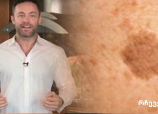 ცნობილი დერმატოლოგის თქმით ამ პროდუქტით შეგიძლიათ მოიშოროთ სახეზე ყავისფერი ლაქები.