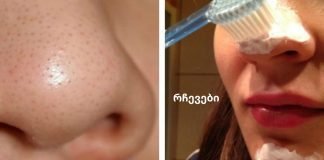 თქვენ არ დაიჯერებთ, რამდენად ადვილია აკნეს მოშორება!