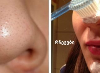 თქვენ არ დაიჯერებთ, რამდენად ადვილია აკნეს მოშორება!