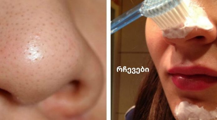 თქვენ არ დაიჯერებთ, რამდენად ადვილია აკნეს მოშორება!