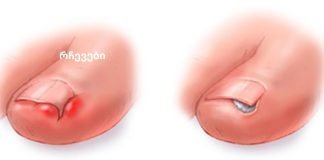 4 საშუალება ჩაზრდილი ფრჩხილების სახლში მკურნალობისთვის!