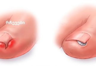 4 საშუალება ჩაზრდილი ფრჩხილების სახლში მკურნალობისთვის!