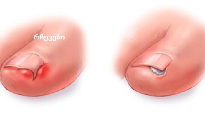 4 საშუალება ჩაზრდილი ფრჩხილების სახლში მკურნალობისთვის!