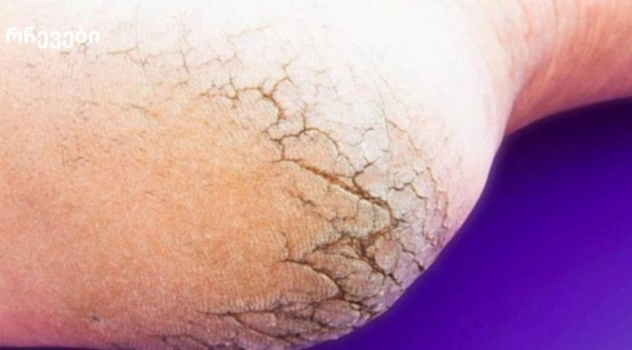 აღარ დახარჯოთ ფული პედიკურზე – მხოლოდ 2 ინგრედიენტი თქვენს სამზარეულოში და თქვენი ფეხები უკეთესად გამოიყურება, ვიდრე ოდესმე!