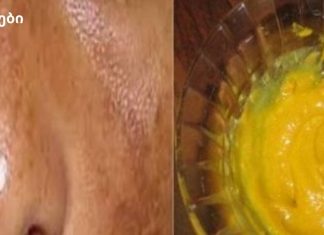 ამ ნარევით ეფექტურად მოიცილეთ მზის სხივების გამო ლაქები და ჰიპერპიგმენტაცია