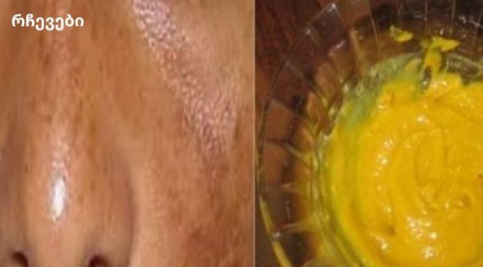 ამ ნარევით ეფექტურად მოიცილეთ მზის სხივების გამო ლაქები და ჰიპერპიგმენტაცია