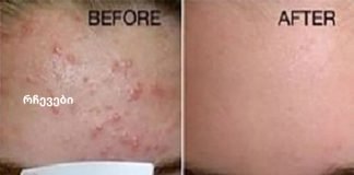 დაემშვიდობეთ ნაოჭებს და გაასუფთავეთ სახის კანი ამ მძლავრი ნაზავით!