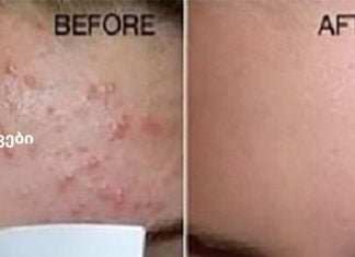 დაემშვიდობეთ ნაოჭებს და გაასუფთავეთ სახის კანი ამ მძლავრი ნაზავით!