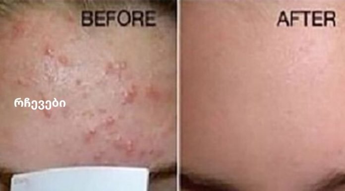 დაემშვიდობეთ ნაოჭებს და გაასუფთავეთ სახის კანი ამ მძლავრი ნაზავით!