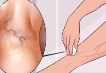 სამუდამოდ მოიშორეთ ვარიკოზული ვენები ერთი მარტივი ინგრედიენტით!