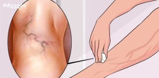 სამუდამოდ მოიშორეთ ვარიკოზული ვენები ერთი მარტივი ინგრედიენტით!