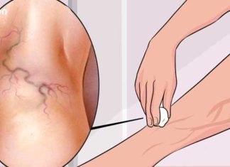 სამუდამოდ მოიშორეთ ვარიკოზული ვენები ერთი მარტივი ინგრედიენტით!