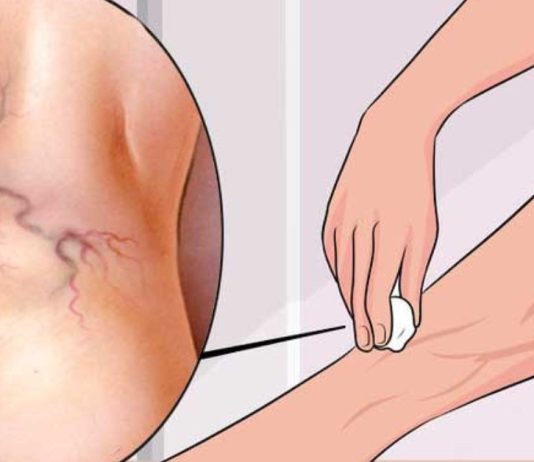 სამუდამოდ მოიშორეთ ვარიკოზული ვენები ერთი მარტივი ინგრედიენტით!